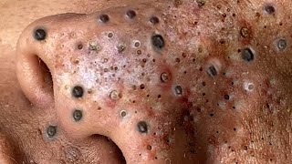 blackheads new 2023 today  blackheads  blackheads new2024 this week blackheads removal [upl. by Yhtommit]