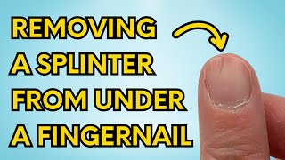 My Simple Trick to Instantly Remove a Splinter From Under Your Fingernail watch until the end [upl. by Bloxberg]