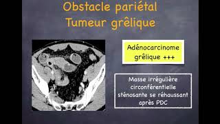 Occlusion intestinale  3 Occlusion grêlique par obstruction [upl. by Ednalrym787]