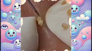 Blackhead Removal Anti Acne Diet Series 4 [upl. by Essirahs]