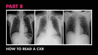 Diaphragms and Pleural Effusion  How to Read a Chest XRay Part 8  MEDZCOOL [upl. by Pardner602]