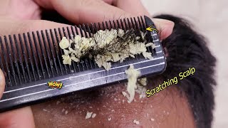 Itchy Dry Scalp Treatment 868  Seborrheic dermatitis [upl. by Werdnaed964]