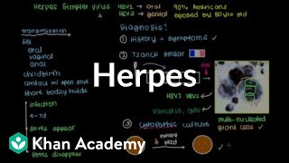 Diagnosis treatment and prevention of herpes  Infectious diseases  NCLEXRN  Khan Academy [upl. by Guyer]