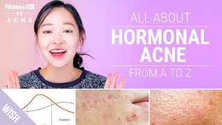 How to Cure Hormonal Acne  Lifestyle amp Skincare Tips  Wishtrend TV VS ACNE [upl. by Akerehs317]