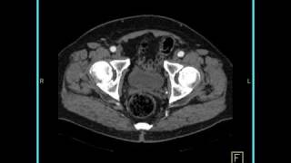 Vascular Right common iliac artery aneurysm Axial [upl. by Kolva368]