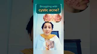 Understanding Cystic AcneTreatments and Management Tips skincare [upl. by Latimore444]