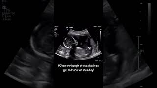 Guess the gender with nub theory  baby boy symptoms pregnancycare pregnancy ultrasound [upl. by Ronn440]