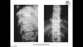 LA SPONDYLODISCITE TUBERCULEUSE ET NON TUBERCULEUSE [upl. by Oinafipe]