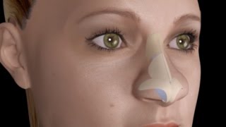 Bulbous Large Nasal Tip Nose Job Rhinoplasty [upl. by Towland]