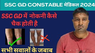 SSC GD KE MEDICAL MAIN KNOCK KNEE KAISE CHEQUE HOTI HAI  SSC GD CARRYING ANGEL KAISE CHECK HOTA HAI [upl. by Noelopan611]