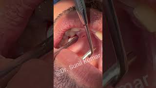 extraction of supernumerary teeth dentalextraction [upl. by Pharaoh99]