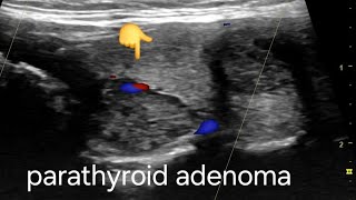 Large Parathyroid adenoma ultrasound and color Doppler video [upl. by Aieken462]