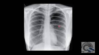 Neumotórax ¿Cómo se ve en radiografías [upl. by Heyes332]