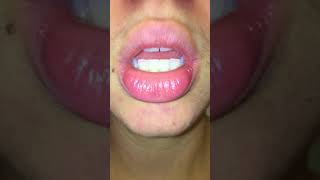 exfoliative cheilitis  day 0 pre treatment  tacrolimus amp burts bees wax hand salve [upl. by Tobin]