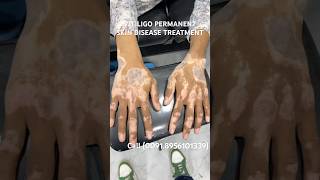 VITILIGO SKIN DISEASE PERMANENT TREATMENT  WHITE SPOTS TREATMENT  LUEKODERMA CURE vitiligocures [upl. by Saleme375]