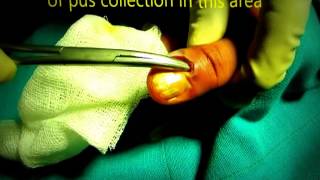 Abscess Nail Fold Paronychia Pus Has To Be Drained Without Delay [upl. by Nac]