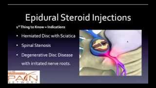 5 Things to Know About Epidural Steroid Injections 602 5076550 [upl. by Aseiram]