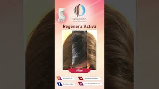 Regenera Activa Results [upl. by Ruhtracam]