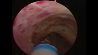 Endoscopic laser urethrotomy Avagyan MC [upl. by Blaire]