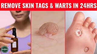 How to Rid Skin Tags and Warts Within 24 Hours  Skin Tag Removal with Garlic amp PovidoneIodine [upl. by Ehrlich]