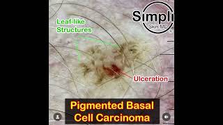 Pigmented Basal Cell Carcinoma Dermoscopy [upl. by Anera760]