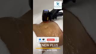 quotSay goodbye to unwanted hair and hello to smooth Laser Hair Removal at RenewPlus Hair amp Skin Care [upl. by Werra710]