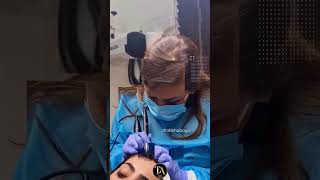 Scalp Micropigmentation timelessaesthetics drshikhabaghi [upl. by Matheson]