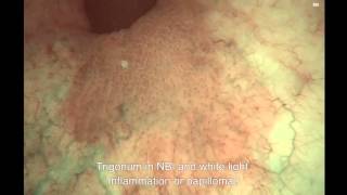 NBI Cystoscopy – Inflammation  Chronic Inflammation [upl. by Stanley]