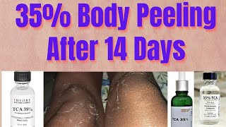 35 TCA Chemical Peel Before After Body Peeling After 14 Day पीलिंग देर से हुई [upl. by Scarlett769]