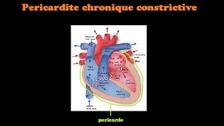 SmartNEasy Cardio  Pericardite Chronique Constrictive  Dr Astuce [upl. by Darelle194]