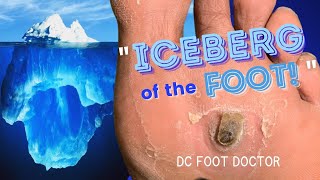 Iceberg of the Foot Removing Painful Pororkeratosis [upl. by Hgieleak]