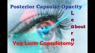 What is Posterior Capsular Opacity amp Yag Laser Capsulotomy Hindi [upl. by Aivatnuhs]