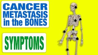 Cancer Metastasis in the Bones  All Symptoms [upl. by Riada]