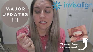 INVISALIGN UPDATE Starting All Over Refinements Gum Recession [upl. by Vigor545]