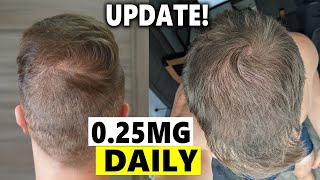 Finasteride Microdosing Update 2022 [upl. by Harbard889]