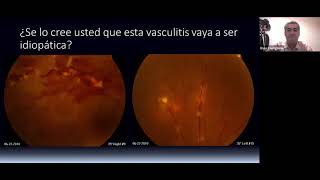 VASCULITIS RETINIANAS  DR ENZO CASTIGLIONE [upl. by Nehemiah399]