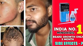 India no1 minoxidil review  mintop minoxidil for beard growth  mintop minoxidil 5 beard growth [upl. by Pronty]