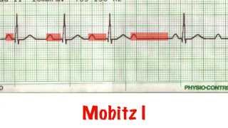 Read a rhythm strip in 5 min [upl. by Wershba20]