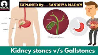 causes and symptoms about kidney stones vs Gallstones and remedies with IMC products [upl. by Rozella]