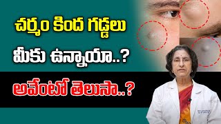 How to Cure Lipoma  Health Tips In Telugu  Skin Care  Dr Chandrathi [upl. by East881]