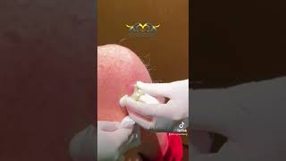 Close up amp Short Cyst 🌋 Video from Las Vegas Dermatology [upl. by Darnoc14]