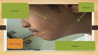 Tinea Corporis aka Ringworm and Pityriasis quotTineaquot Versicolor [upl. by Alyam]