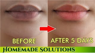 काले होंठो प्राक्रतिक गुलाबी बनाने के नुस्खे  Remove darkness from lips get pink lips [upl. by Ellette]