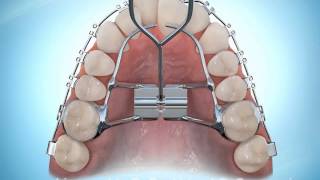 Hyrax Rapid Palatal Expansion Braces During [upl. by Veleda749]