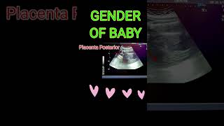 BABY GENDER VS PLACENTA shortsfeedpregnancy [upl. by Toor]