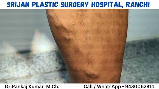 Laser treatment of varicose veins Best treatment of varicose veins varicose veins treatment [upl. by Halford]