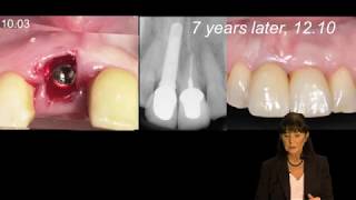 Immediate vs late implantation replacing multiple adjacent missing teeth in the anterior maxilla [upl. by Netsirc]