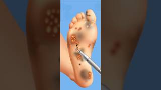 ASMR treatment Psoriasis Pimple Pus amp Blackhead Removal animation video [upl. by Arratoon]