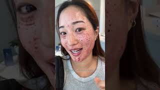 i got salmon sperm injected in my skin husbands reaction rejuran skintreatment skinclinic [upl. by Ahgem]