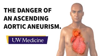 Surgeon describes an ascending aortic aneurysm  UW Medicine [upl. by Elisha]